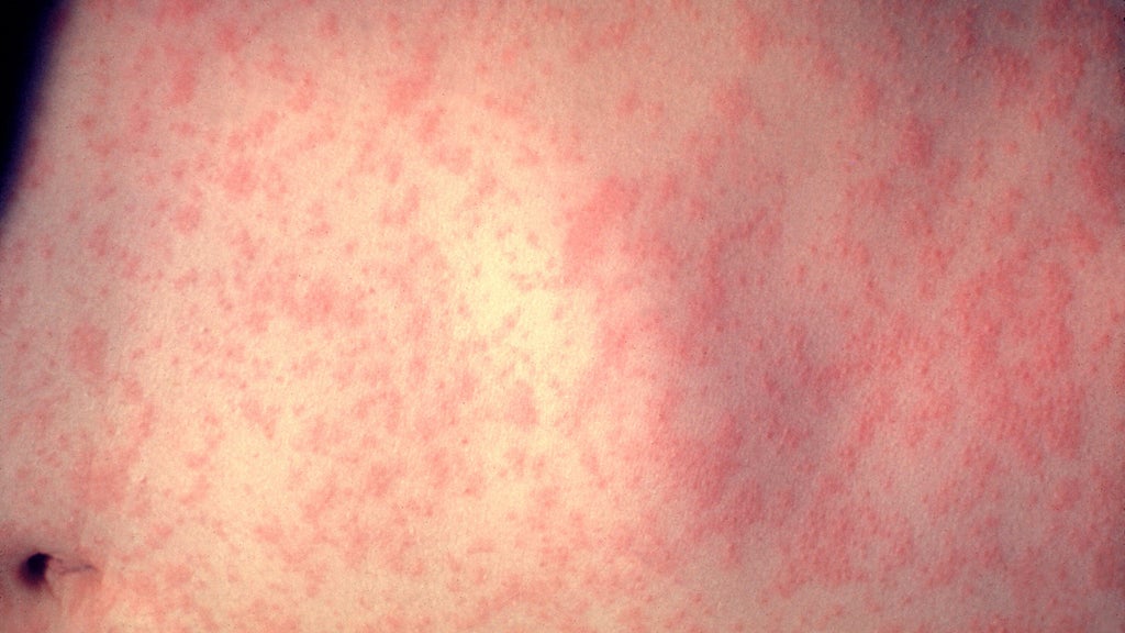 25 cases of measles identified in central, southeastern Minnesota, MDH says — WCCO / CBS Minnesota, St. Louis Park Health news
