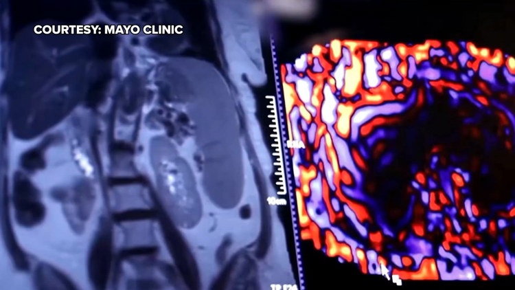 Healthy SA: Battling liver cancer, a disease which often has no symptoms early on — KENS 5 (San Antonio), St. Louis Park Health news